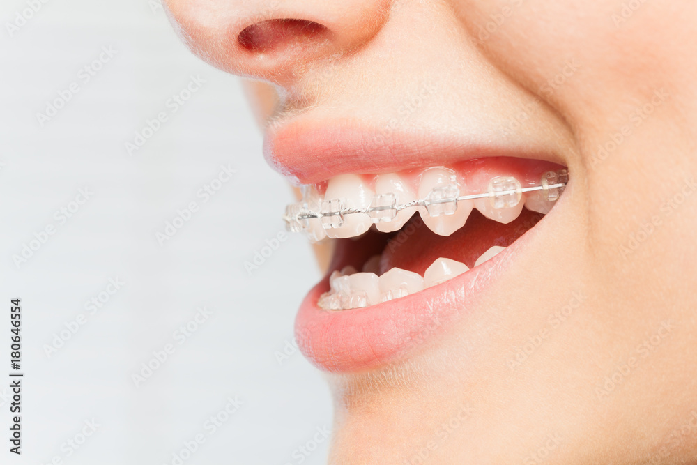 女性面带微笑，牙齿上戴着清晰的牙套