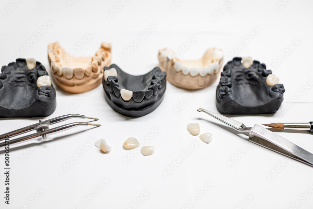 白色背景上有植入物、贴面和牙科器械的人造石膏颌模型。