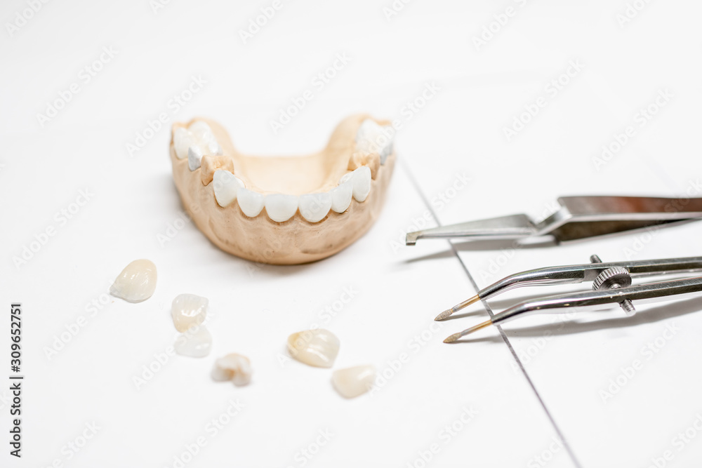白色背景上有贴面和牙科器械的人造石膏颌模型。概念