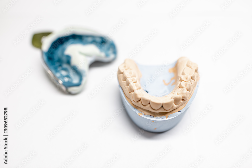 白色背景上有印模的人造石膏颌模型。义齿模具制造