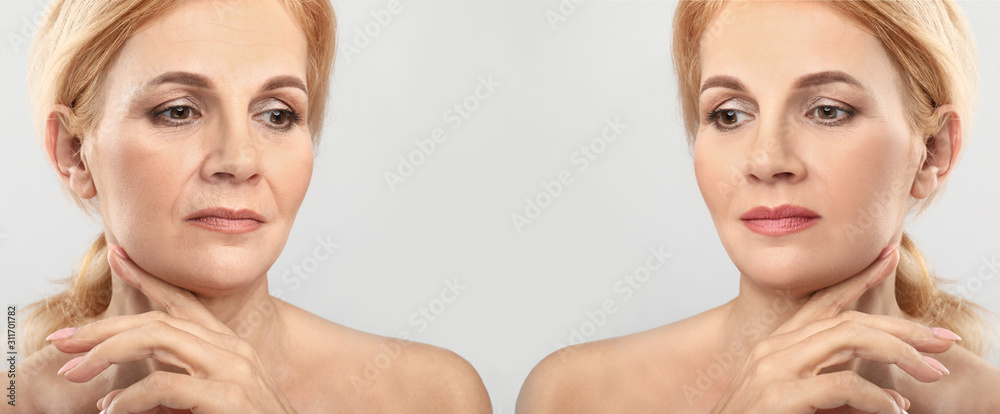浅色背景下中年女性注射填充剂前后对比画像