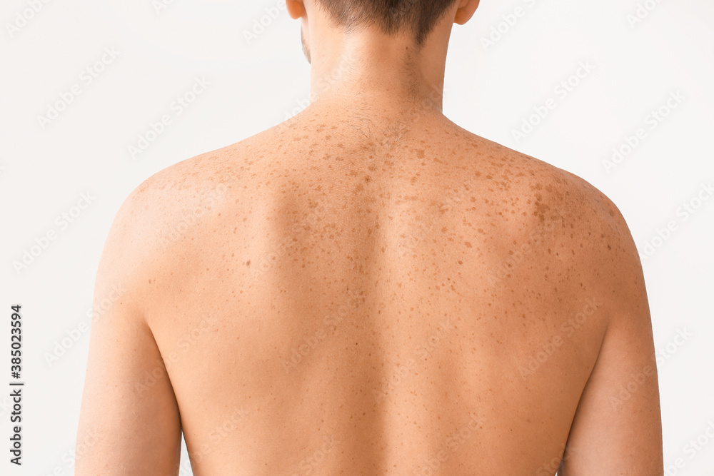 Man with freckles on light background