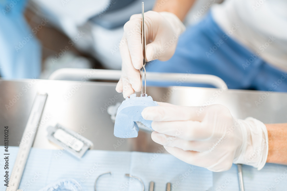 正畸医生使用下颌模型应用支架系统，为患者建模正畸治疗
