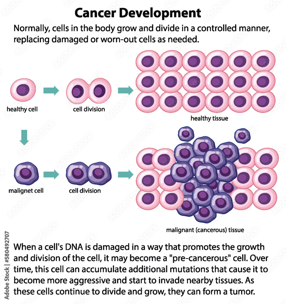 Cancer Development vector with information